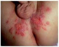 Foto Merk Obat Gatal Selangkangan Ruam Wanita Hamil