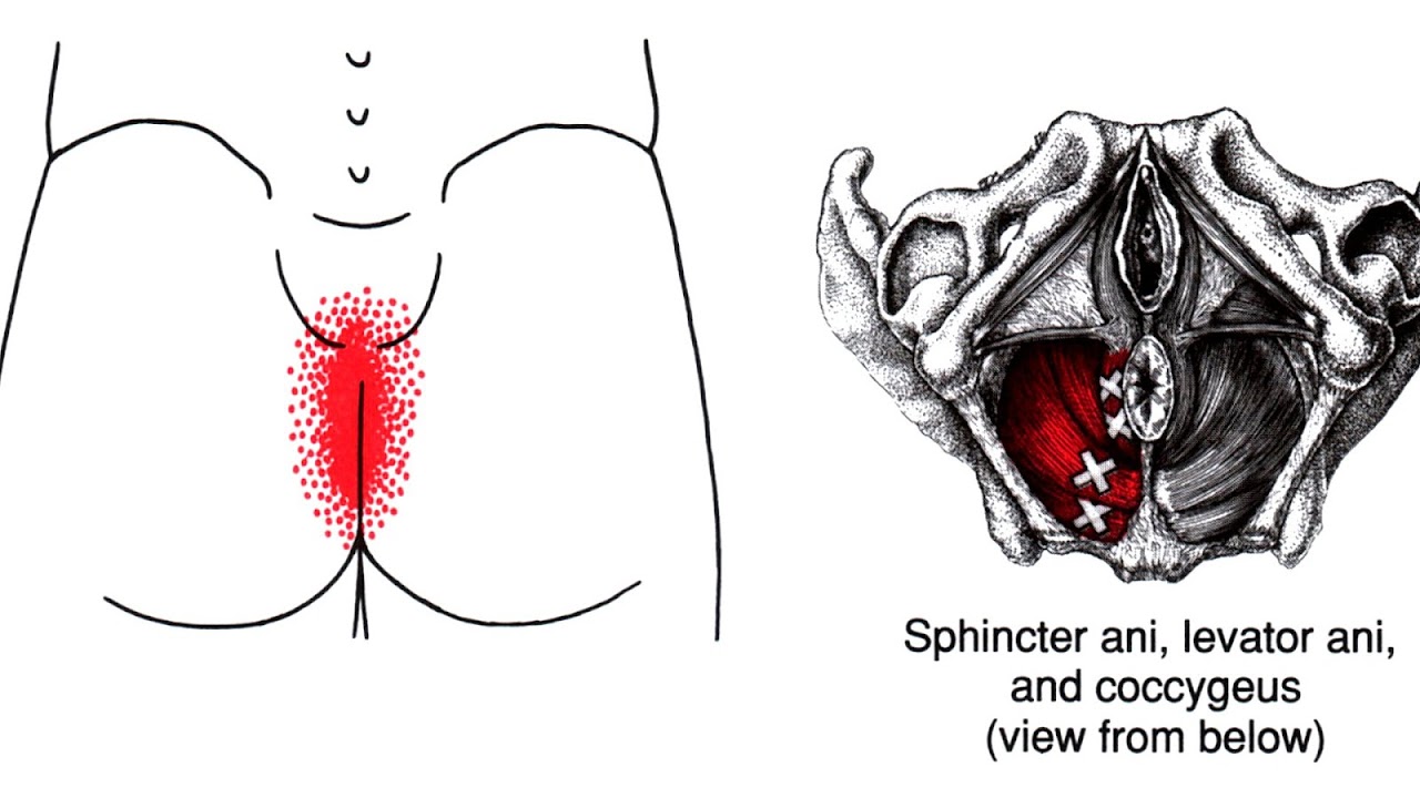 Severe Tailbone Pain Without Injury Injury Choices