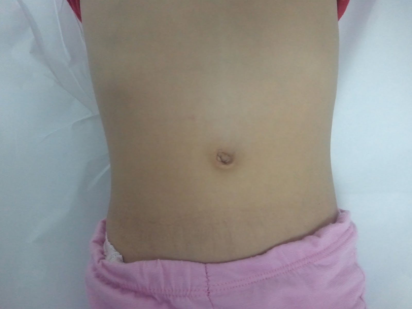 Dr. Rafael Correia: Hérnia umbilical