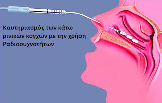 Καυτηριασμός ρινικών κογχών