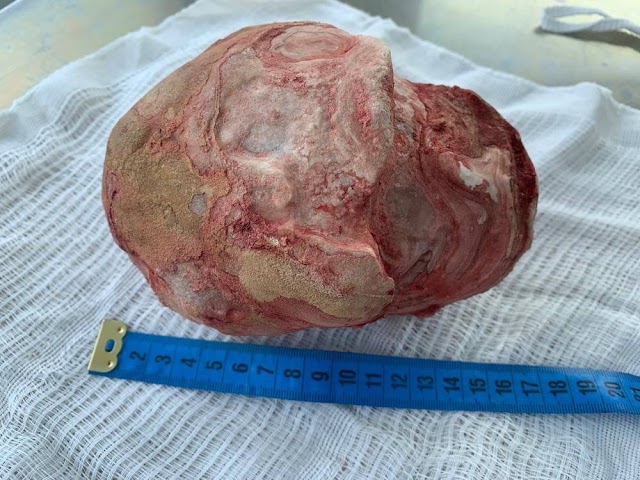 Homem de 51 anos tem pedra de 1,3kg retirada da bexiga na Bahia