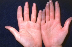 Morbus Raynaud : Symptome Ursachen und Abhilfen