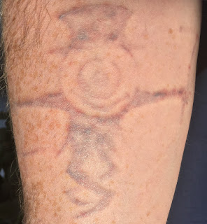 Laser Tattoo Removal Tattoo 48 hours after picosure laser removal