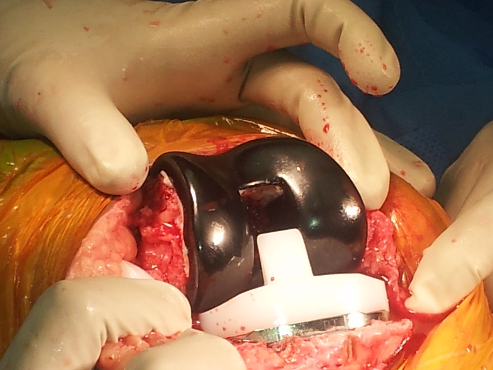 Best Orthopaedic Surgeon Chennai, India Dr.A.K