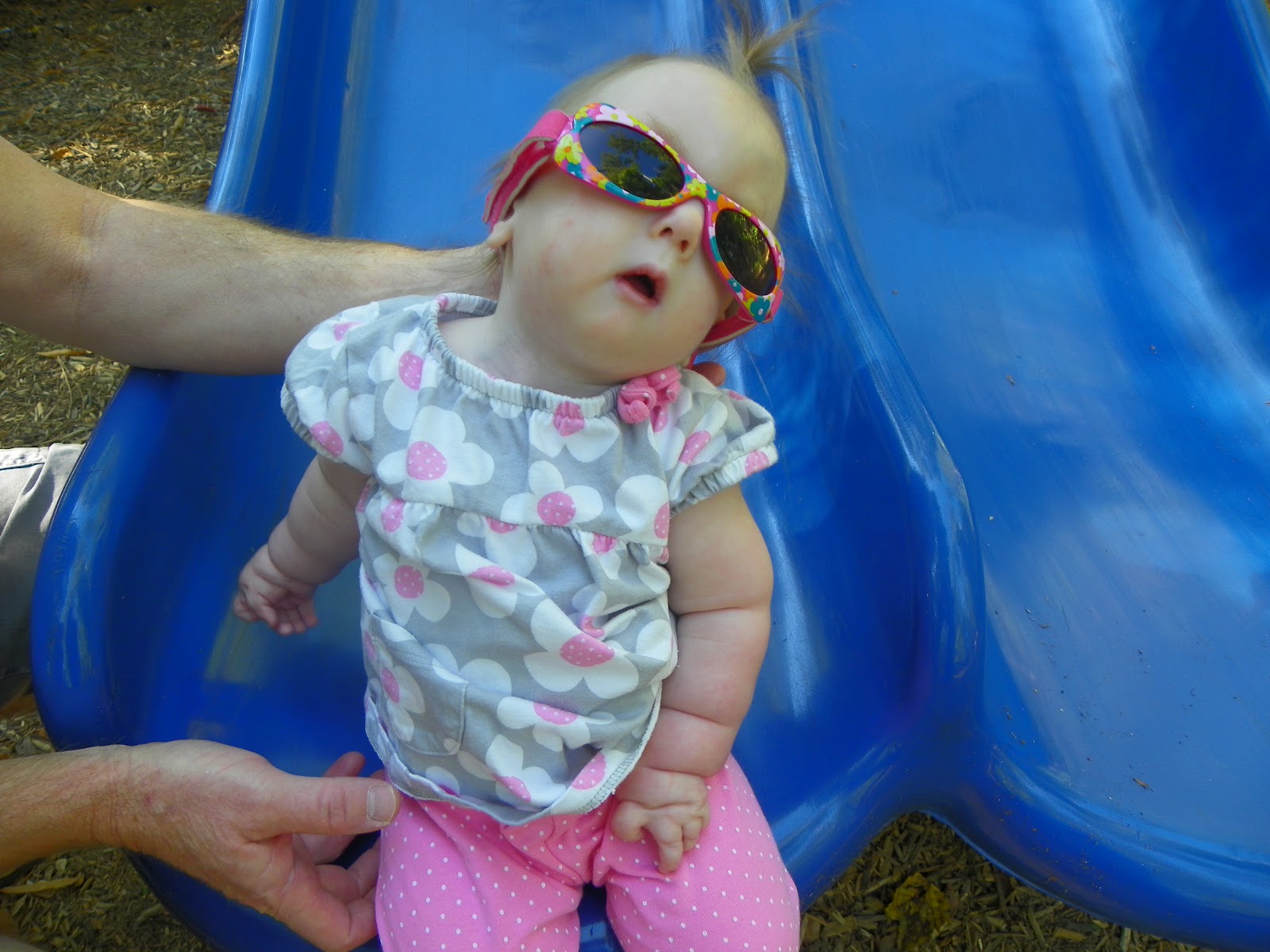 Pray For Lilly Lilly's Trisomy 18 physical features Part 2