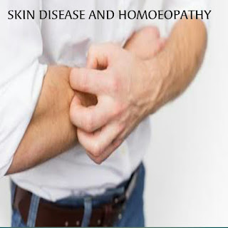 Skin Disease And Homoeopathy
