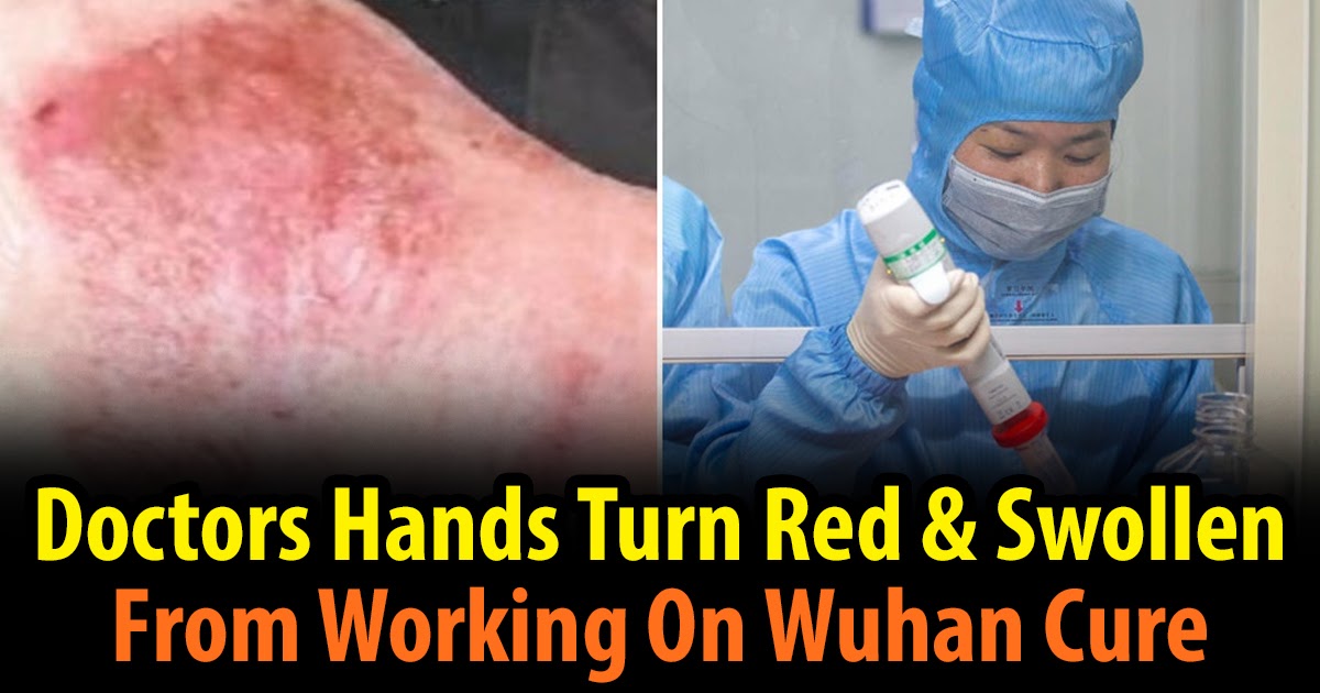 Doctors Hands Turn Red & Swollen From Working On New China Virus Cure