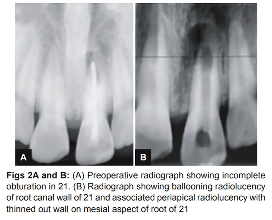 PDF Management of Internal Resorption with Perforation