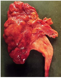 Pielonefritis daño renal con cogestion