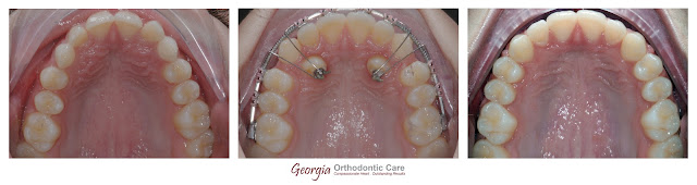 Orthodontic Treatment of Double Maxillary Canine Impaction in the Palate, Georgia Orthodontic Care