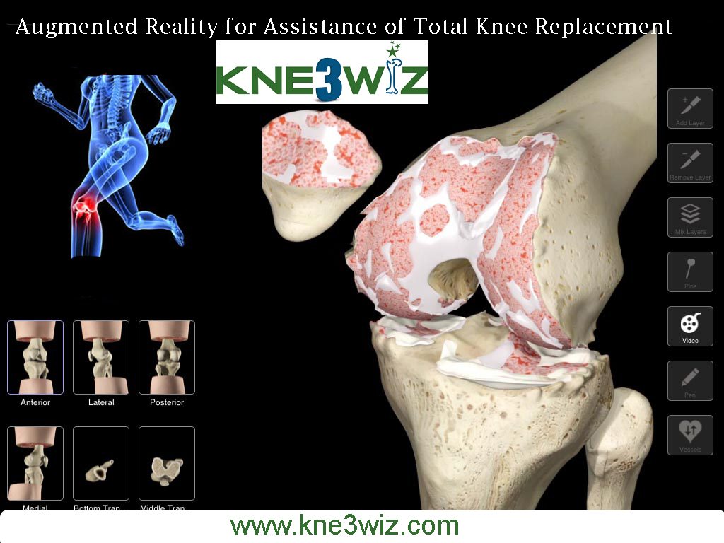 Kne3wiz is best of Knee Replacement. Surgery for Hip Joint with 3d