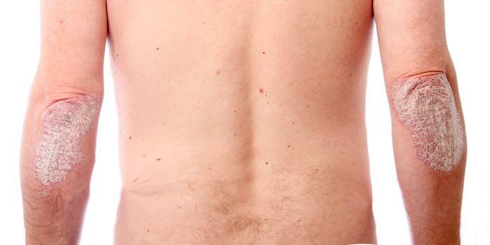 Psoriasis medicina natural tratamiento