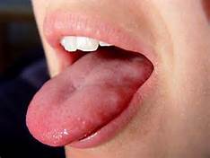 Effective Natural Treatments for Oral Thrush