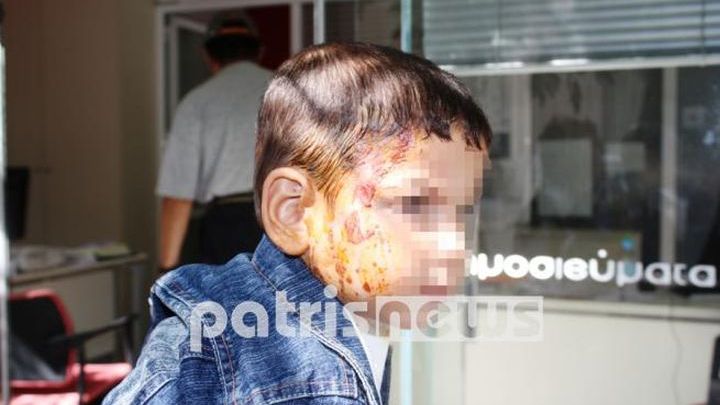 Σε 34 μήνες φυλάκιση ο άνδρας που έλουσε με καυτό καφέ δίχρονο αγοράκι στην Ηλεία Σε 34 μήνες φυλάκιση ο άνδρας που έλουσε με καυτό καφέ δίχρονο αγοράκι στην Ηλεία