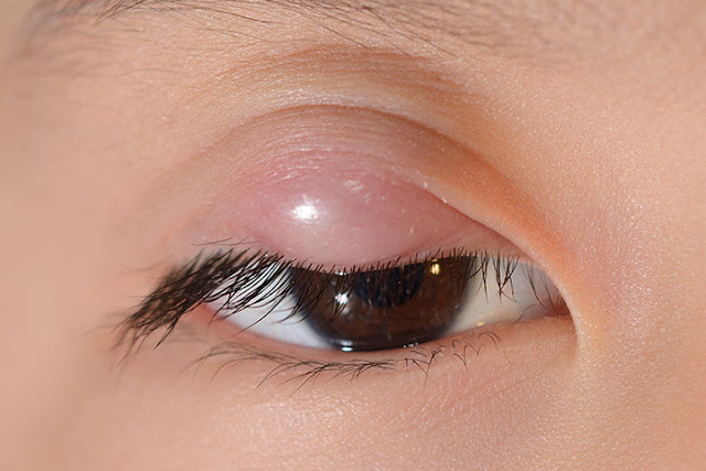 Most Effective Treatment for Stye in Eye Most Effective Treatment for Stye in Eye