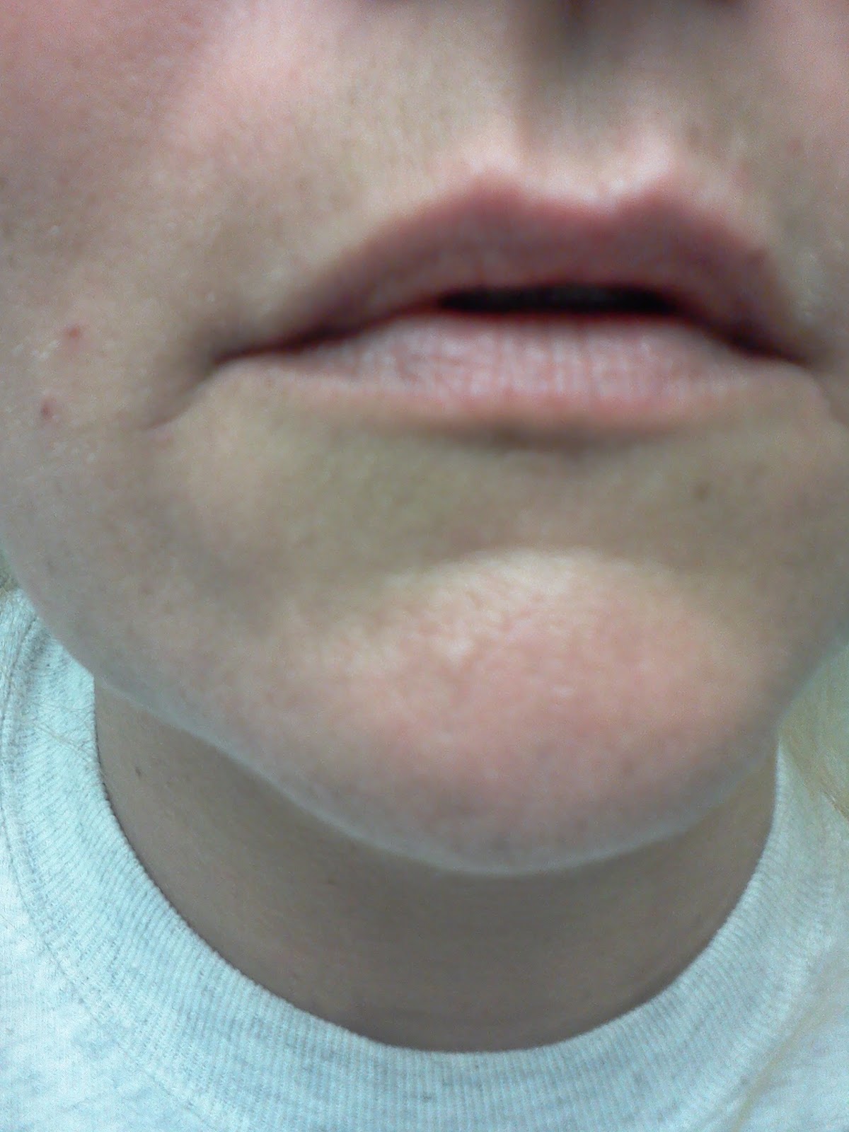 Life with Lupus Symptoms from mild to severe. These are just a few.