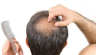  Tidak sedikit orang yang mengalami problem kebotakan pada rambutnya 6 Tips Alami Menumbuhkan Rambut Botak Dengan Cepat