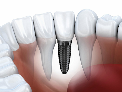 Dental implant cost in Sydney
