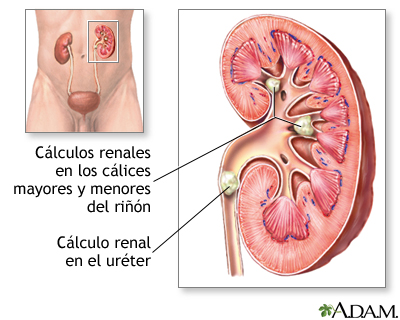 eyaculación dolorosa cálculos renales