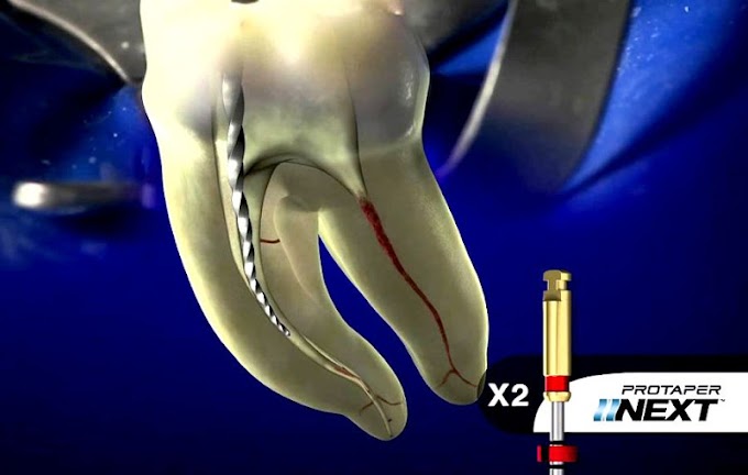 WEBINAR: Protaper Next con Obturación 3D en Endodoncia - Dr. José Aranguren