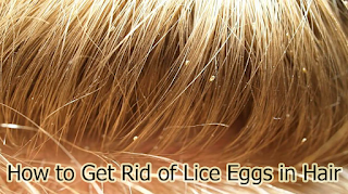 How to Get Rid of Lice Eggs in Hair