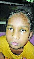 Stem Cell Eye Treatment In Sirsa, India, 9 year old kid eye treatment