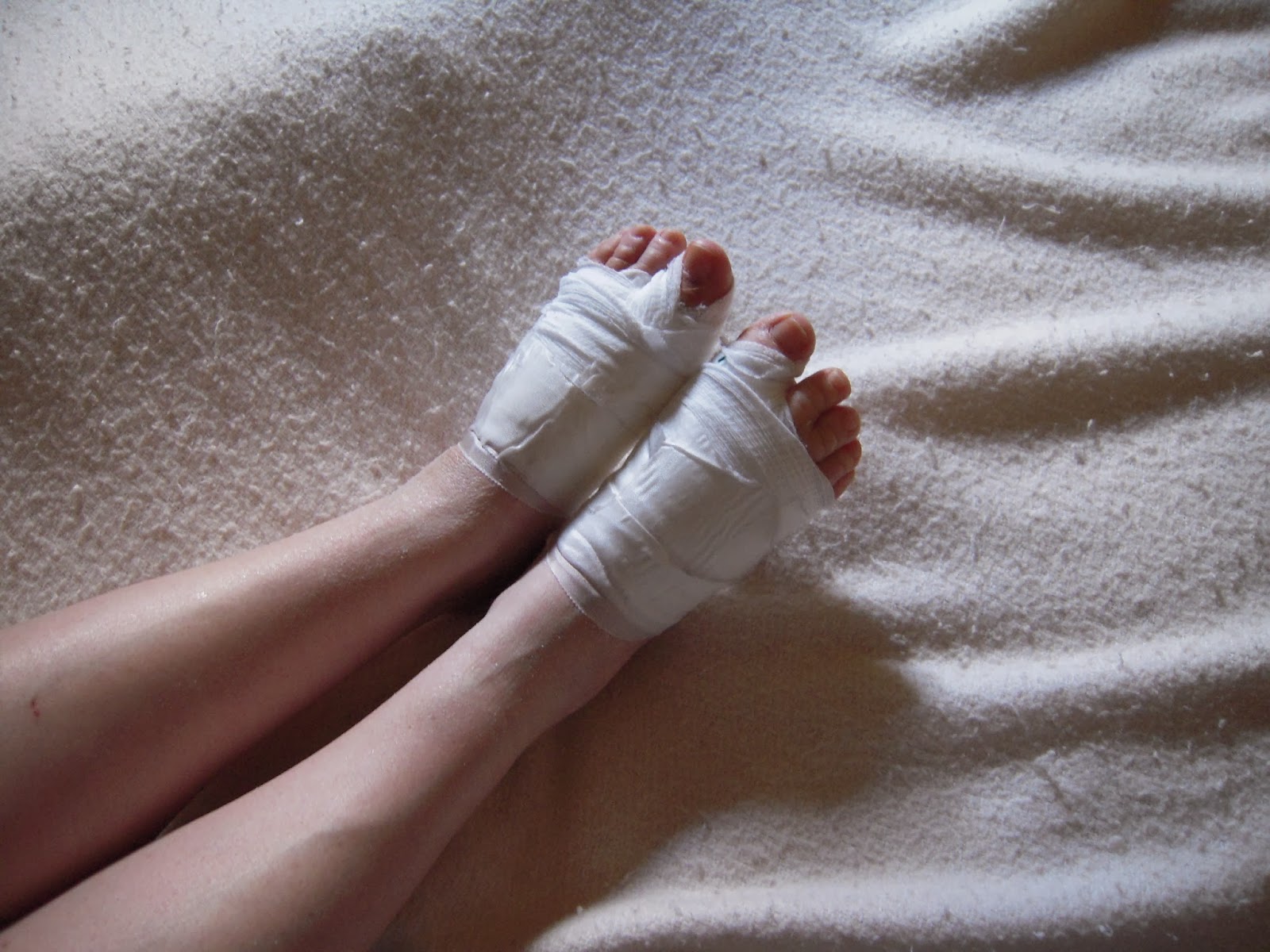 Can I have my bunions on both feet operated on at the same