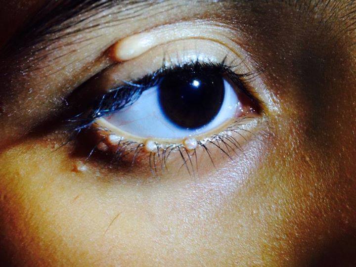 White Bump On Eyelid Eyelid Bumps 101 How To Identify Styes Milia