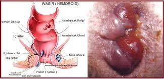 https://1.bp.blogspot.com/-lPcmmOVbboI/WIlyyWQGYTI/AAAAAAAAAJQ/FxgdLWMyv88-GzsIqK1nGvIyeFI5fM0GACLcB/s1600/penyakit-ambeien-pada-wanita.jpg