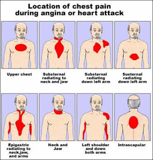 Serangan Jantung