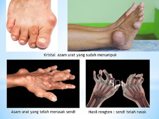 Gejala Asam Urat Dan Pantangan Makan, Asam Urat Olahraga, Standar Asam Urat Wanita, Cara Menyembuhkan Asam Urat Di Tangan, Obat Herbal Asam Urat Dan Maag, Cara Mengobati Asam Urat Secara Tuntas, Obat Asam Urat Yang Bagus Apa, Cara Mengobati Asam Urat Yang Tinggi, Obat Asam Urat Terbaik, Cara Mengobati Asam Urat Dan Rematik, Mengapa Asam Urat Rendah, Cara Pengobatan Asam Urat Akut, Makanan Yang Dilarang Asam Urat, Apa Obat Asam Urat Secara Alami, Cara Menyembuhkan Penyakit Asam Urat Di Kaki, Mengatasi Penyakit Asam Urat, Cara Cepat Meredakan Nyeri Asam Urat, Obat Herbal Untuk Asam Urat Atau Rematik, Obat Asam Urat Dari Daun Binahong, Obat Asam Urat Yang Sangat Ampuh, Ukuran Cek Asam Urat, Faktor Penyebab Asam Urat, Asam Urat Dan Cara Mengatasinya, Obat Alami Yang Bisa Menyembuhkan Asam Urat, Obat Asam Urat Dan Rematik Alami, Cara Ngobati Asam Urat Alami, Asam Urat Menyebabkan Batu Ginjal, Pengobatan Penyakit Asam Urat Secara Tradisional, Obat Penyakit Asam Urat Yg Alami, Buah Yang Cocok Untuk Obat Asam Urat