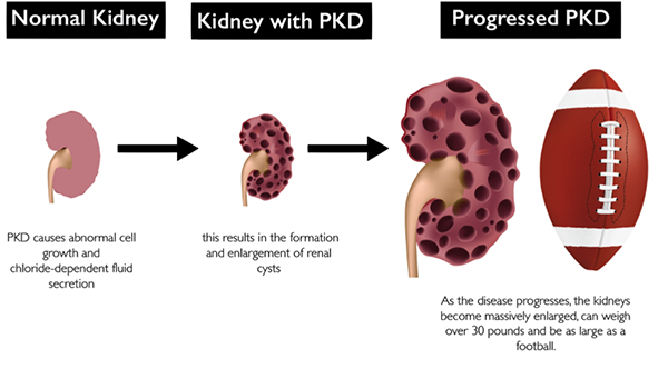 Treatment For Kidney Disease Stages Of Polycystic Kidney Disease PKD 