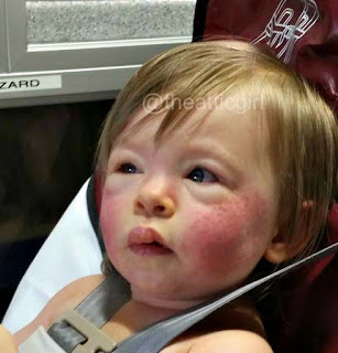 Anaphylaxis Food Allergies, Food Allergy Awareness