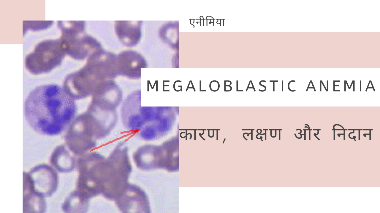 Megaloblastic Anemia कारण, लक्षण और निदान