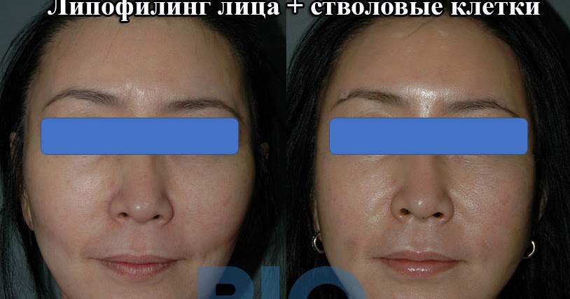 Липофилинг лица фото до и после цена в спб. Липофилинг ростов на дону. Птоз нижней трети лица. Липофилинг ягодиц фото до и после. Липофилинг ростов на дону.