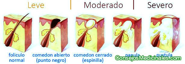 Espinillas en la vagina, mesir pron
