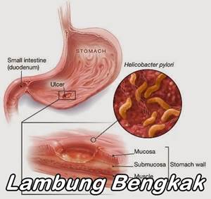 Obat Lambung Bengkak Alami Dengan Kerja Cepat