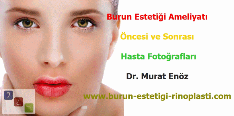 Burun Estetiği Öncesi ve Sonrası Görüntüleri