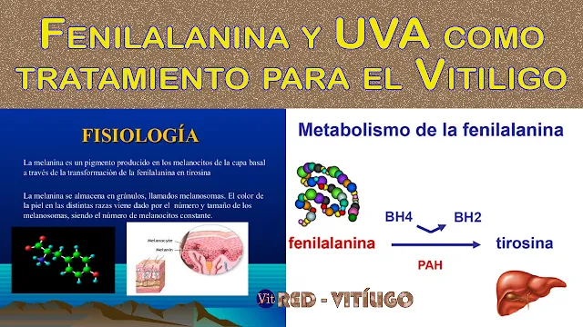 Fenilalanina y UVA como tratamiento para el Vitiligo