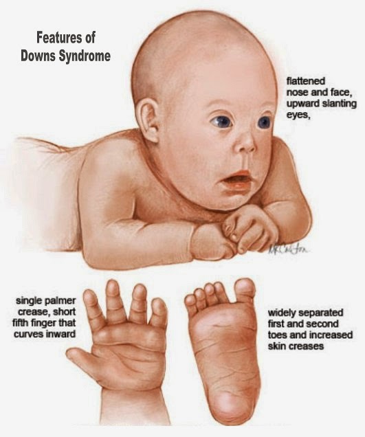 Blood Test For Down's syndrome Screening In Pregnancy