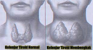 Obat Kelenjar Tiroid Tradisional Obat Kelenjar Tiroid Tradisional