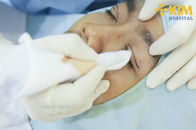 Tại KIM Hospital, với kỹ thuật thực hiện tỉ mỉ khéo léo, cùng công nghệ hiện đại, bạn không phải lo lắng bấm mí mắt sưng bao lâu