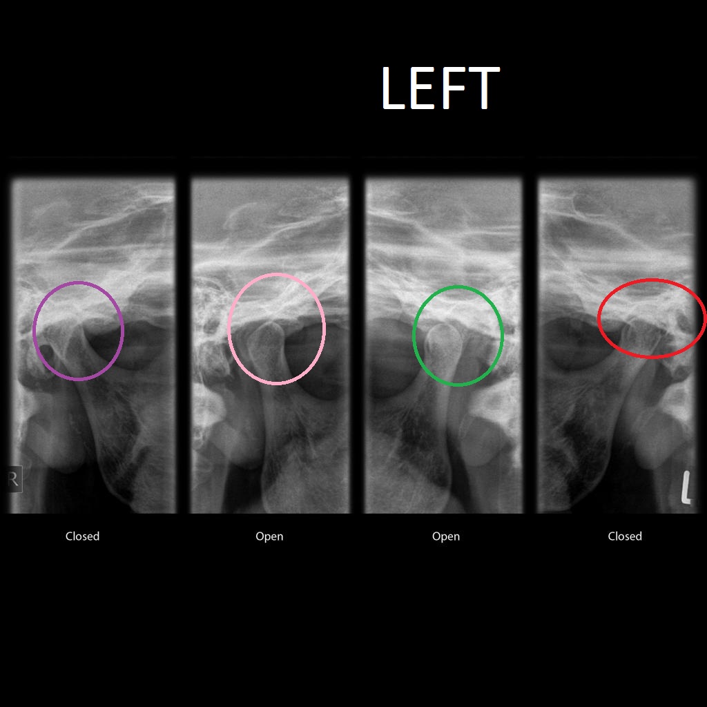 Karen Berkatakata Sakit Rahang tidak bisa menutup, TMJ
