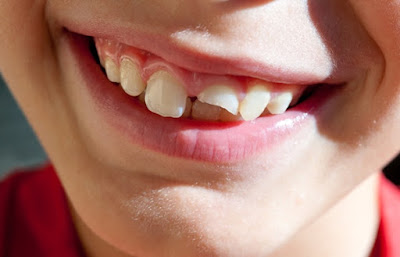 Có cần thiết phải hàn răng bị vỡ hay không?