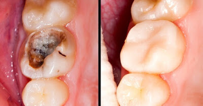  Quy trình trám răng điều trị tại nha khoa