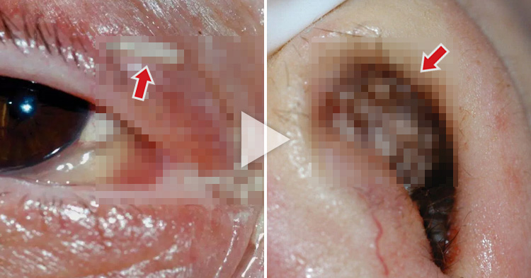 Large quantity of maggots were extracted from eyes and nose of a woman