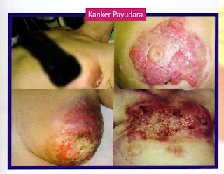 kanker payudara kanker payudara