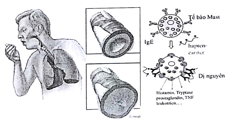 học Y: Sử dụng thuốc điều trị hen phế quản và COPD