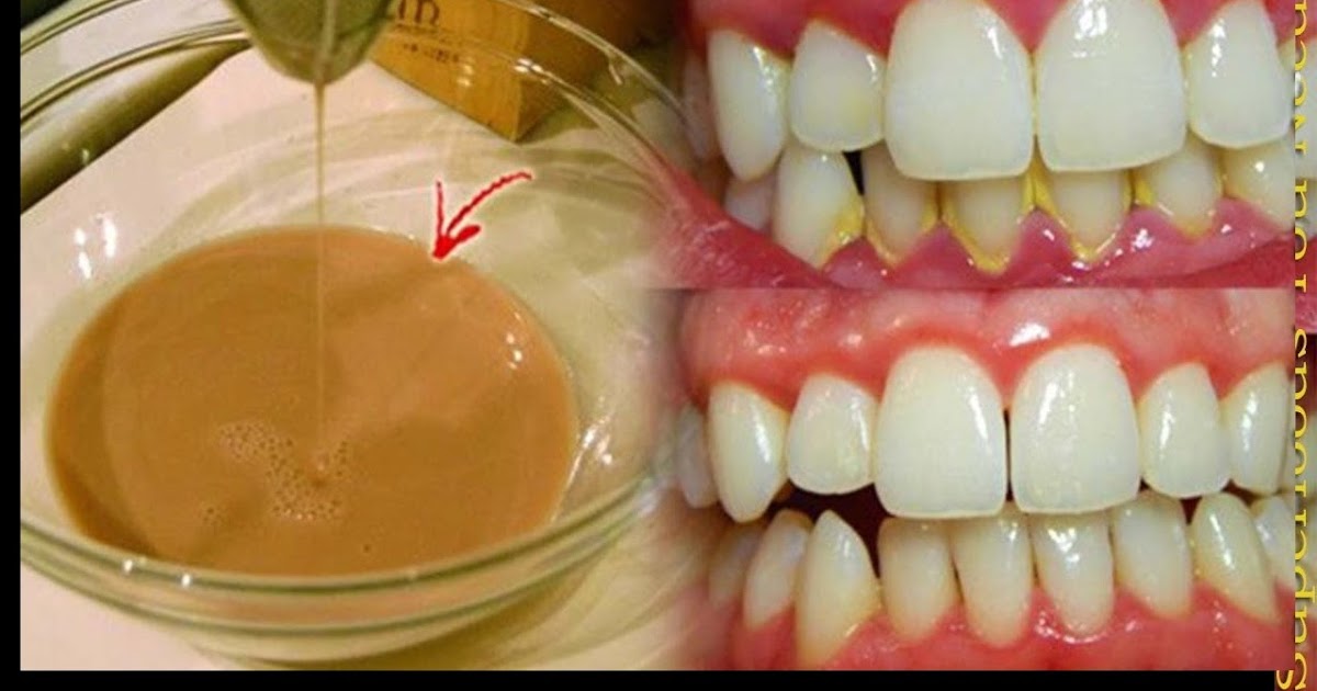 Mouthwash Removes Plaque From Teeth In 10 Minute