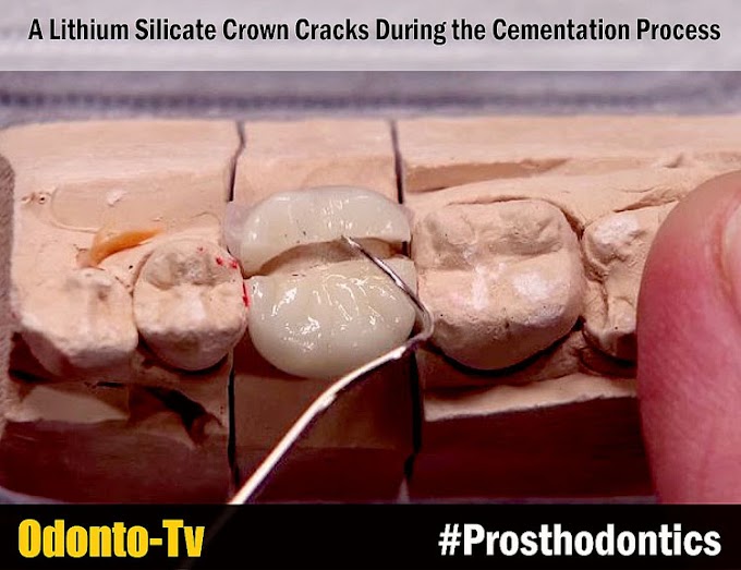PROSTHODONTICS: A Lithium Silicate Crown Cracks During the Cementation Process